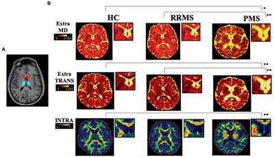 In-vivo characterization of macro- and microstructural injury of the subventricular zone in relapsing-remitting and progressive multiple sclerosis